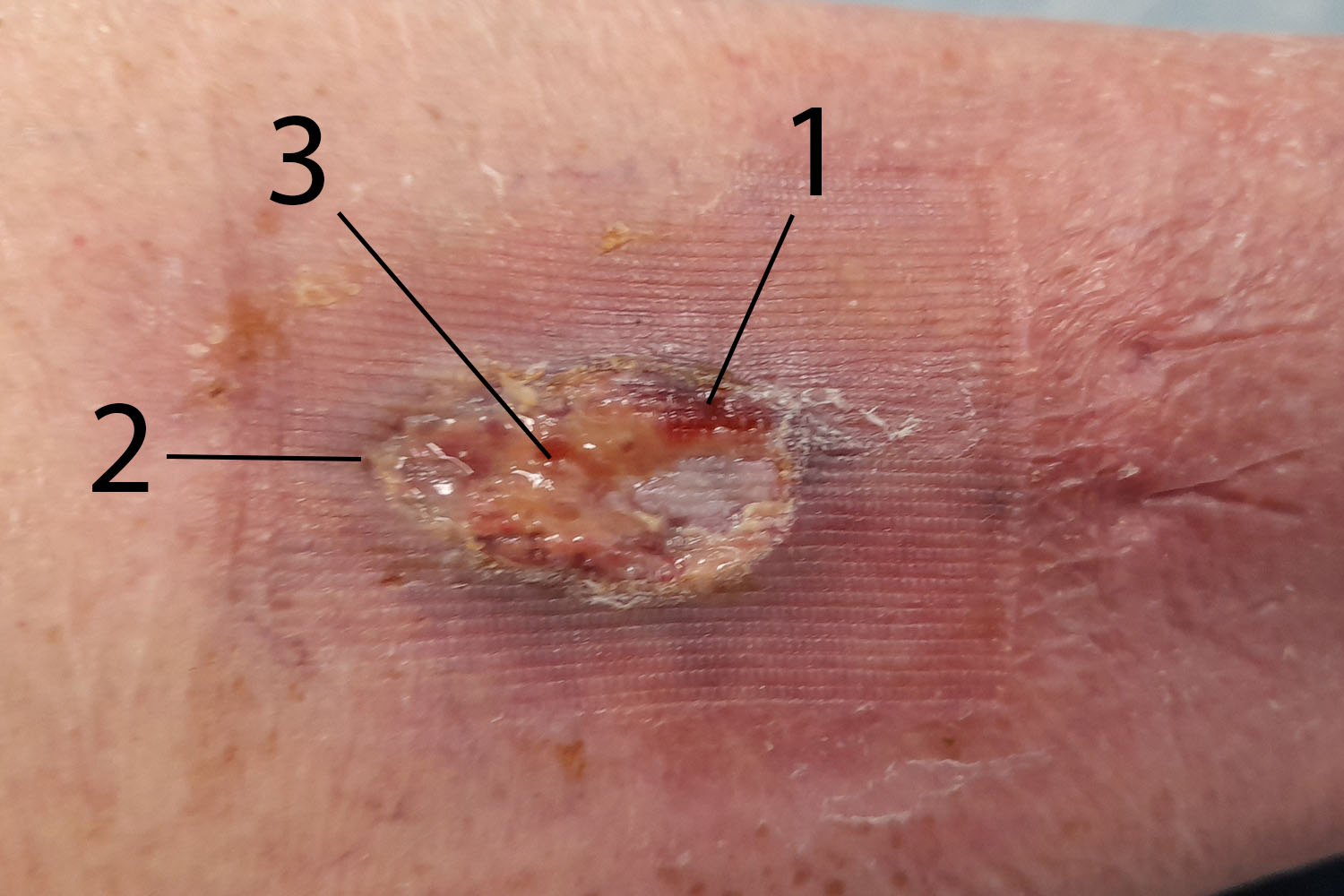 wound at first presentation